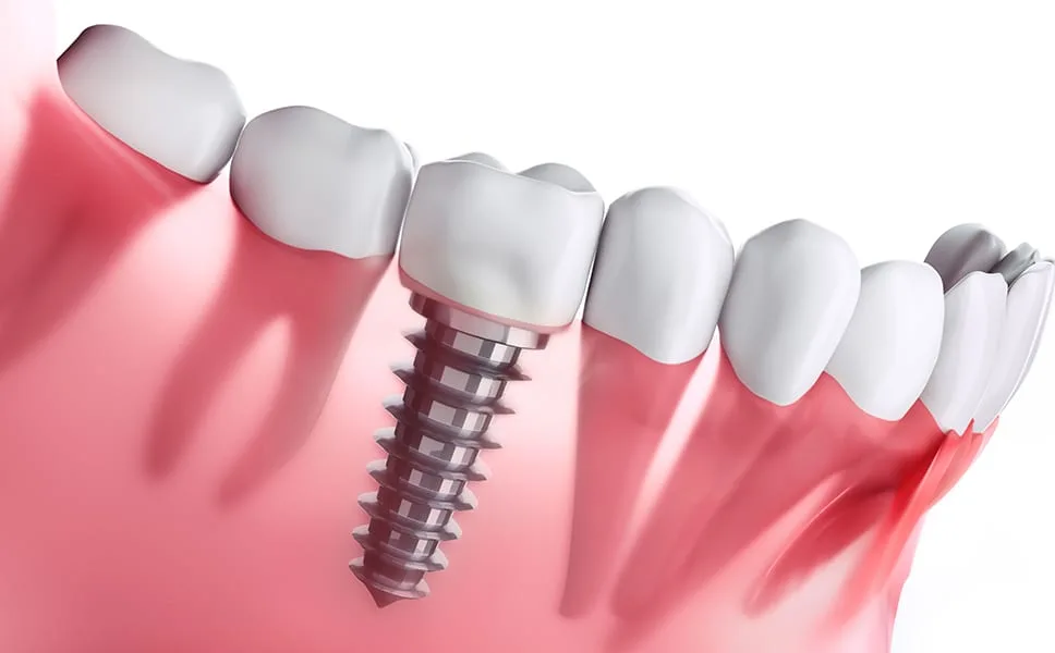 Simpladent Clinics Visakhapatnam - Revolutionizing Dental Implants with Minimally Invasive Techniques Simpladent Clinics Visakhapatnam - Revolutionizing Dental Implants with Minimally Invasive Techniques image 1