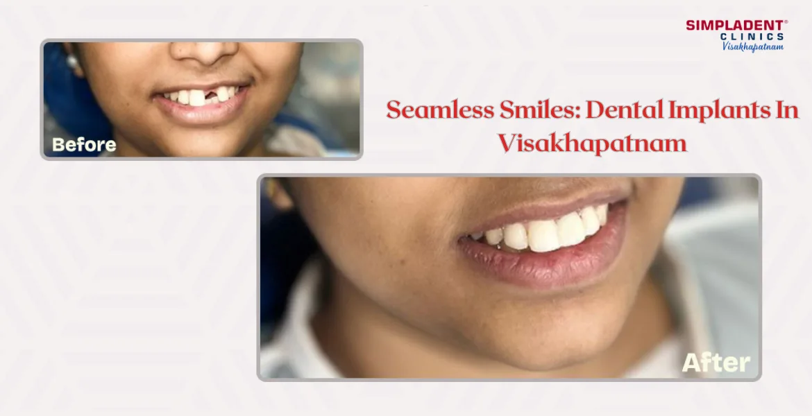Simpladent Clinics Visakhapatnam - Seamless Smiles: Dental Implants In Visakhapatnam Dental Implant Procedure, Tooth Replacement Solution, Best Dental Implants, Quick Dental Implant Treatment, Affordable Implant Dentistry
